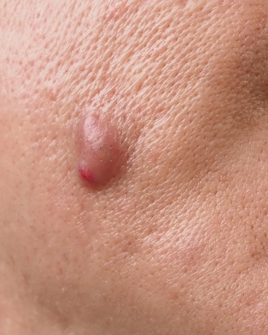 Sebaceous cyst excision at Cinch Clinics
